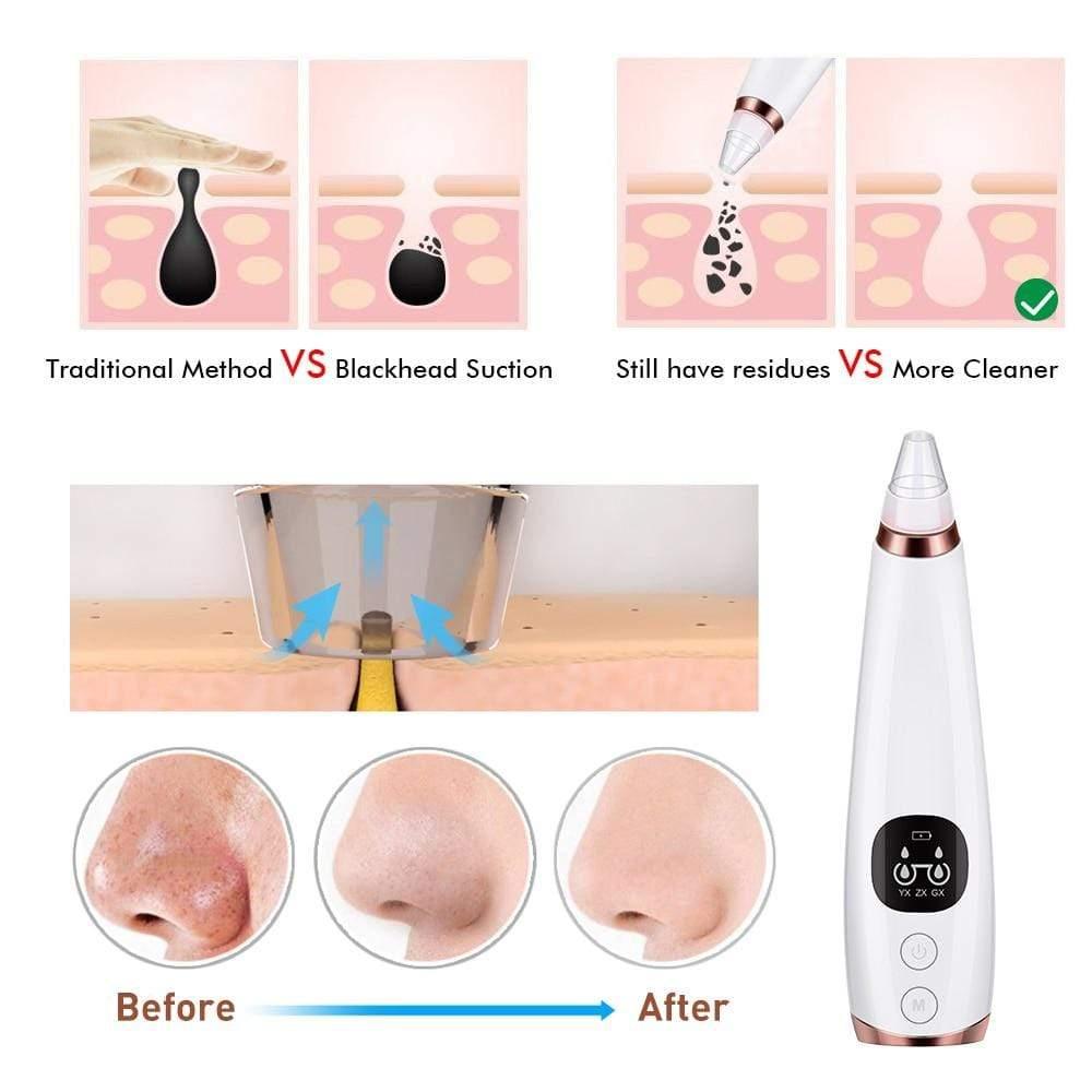 Blackhead Remover Vacuum Pore Cleaner - Ammpoure Wellbeing
