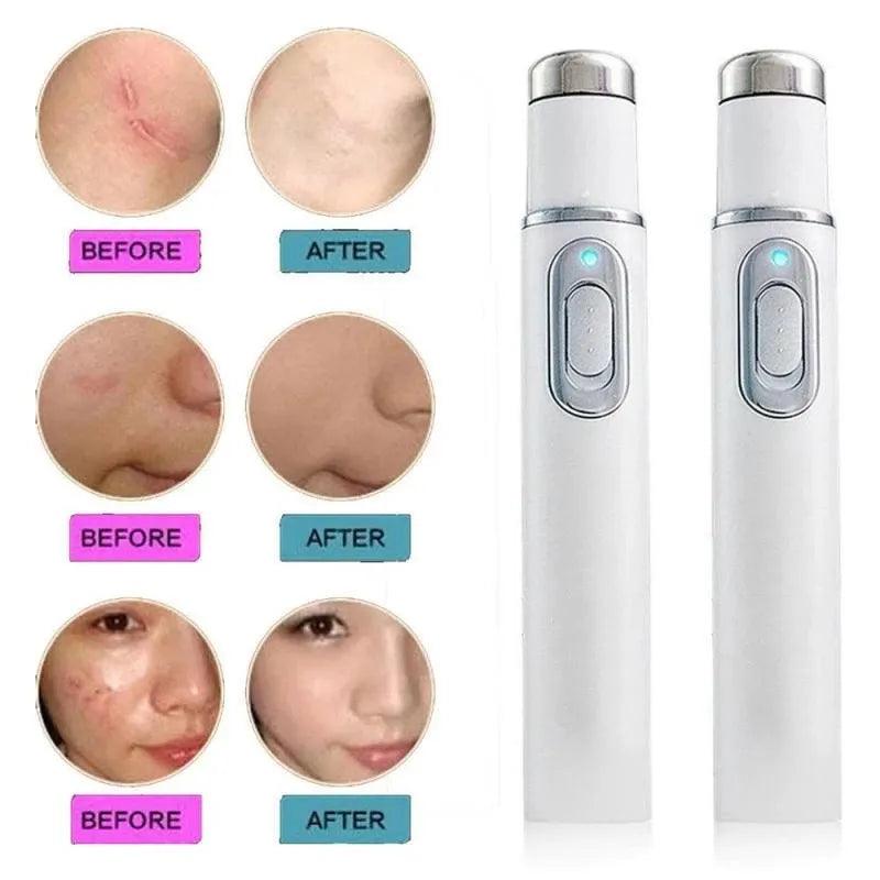 Blue Light Facial Machine Acne Wrinkle Removal Laser Pen Skin Spots Removal Anti Varicose Spider Vein Eraser Medical Treatment - Ammpoure Wellbeing