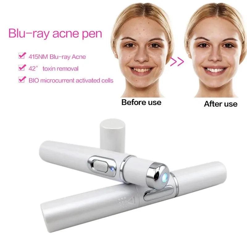 Blue Light Facial Machine Acne Wrinkle Removal Laser Pen Skin Spots Removal Anti Varicose Spider Vein Eraser Medical Treatment - Ammpoure Wellbeing